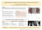 McKenna, Mary Clare: Congenital thenar hypoplasia masquerading as carpal tunnel syndrome
